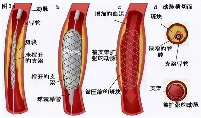 心脏支架一年，我在三十岁的转变